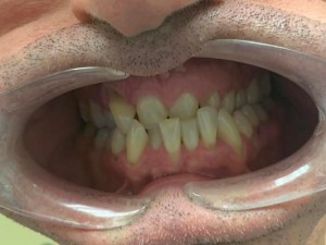 Up close photo of teeth before invisalign