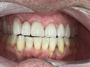 Up close photo of teeth before invisalign