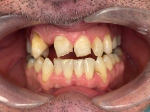 Up close photo of teeth before invisalign