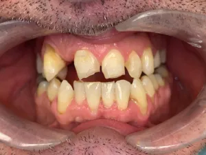 Up close photo of teeth before invisalign